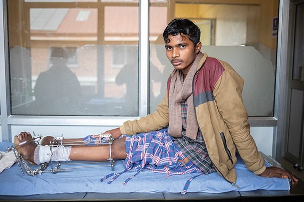 Jitesh in Nepal received surgery and physical rehabilitation for his severe clubfoot
