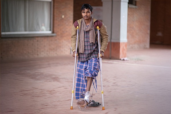 Jitesh in Nepal received surgery and physical rehabilitation for his severe clubfoot