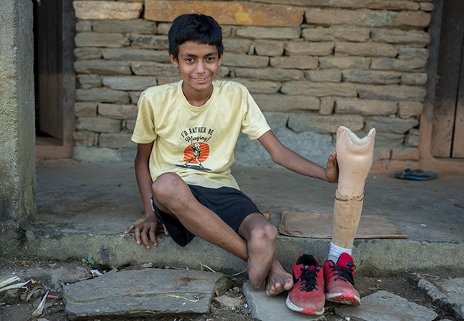 Sarbendra in Nepal receiving a new prosthetic limb and physical rehabilitation