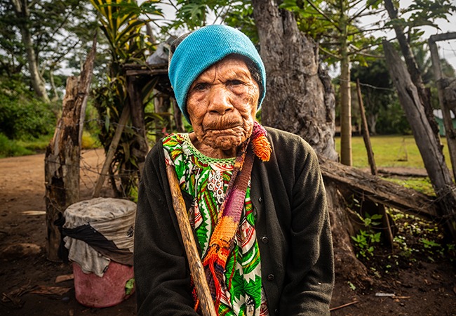 Gepeso received sight-saving cataract surgery at a cbm-funded hospital in Papua New Guinea