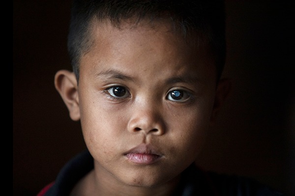 Kyle receives sight-saving cataract surgery in the Philippines